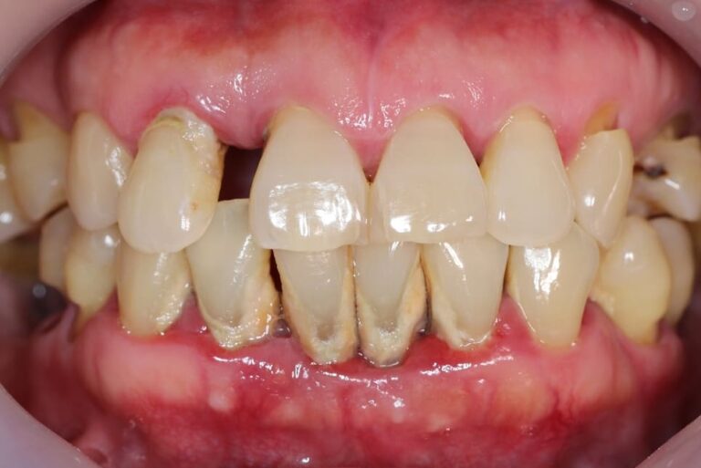 FM Dental . Dentista Biella - Parodontite