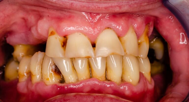 FM Dental - Dentista Biella - Parodontite1