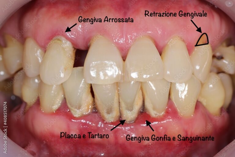 Parodontite - FM Dental - dentista Biella