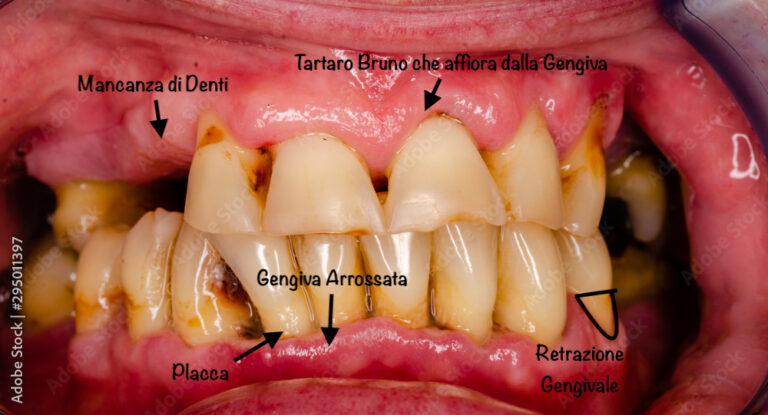 Piorrea - FM Dental - Dentista Biella